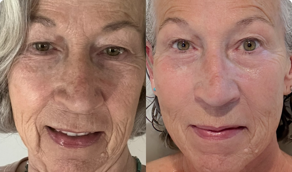 Joan Before After